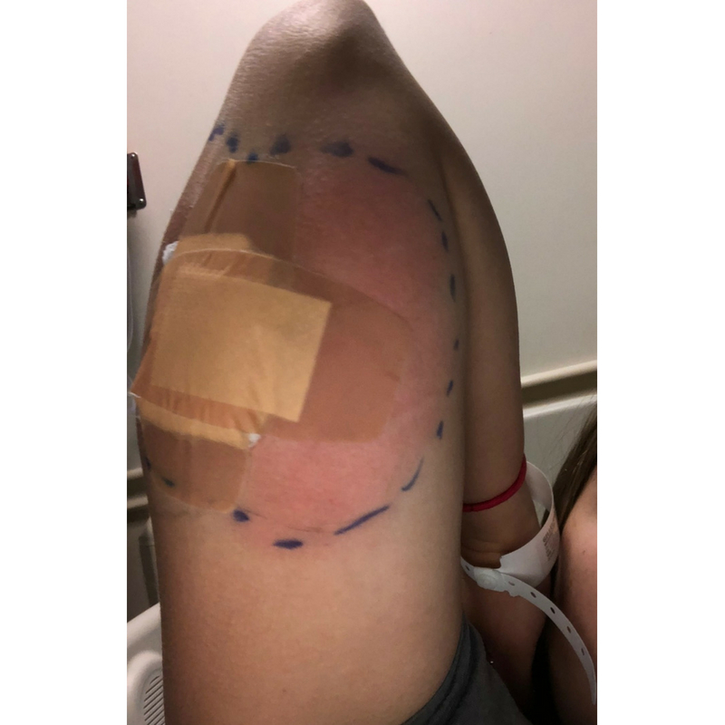 infection from insulin pump - omnipod